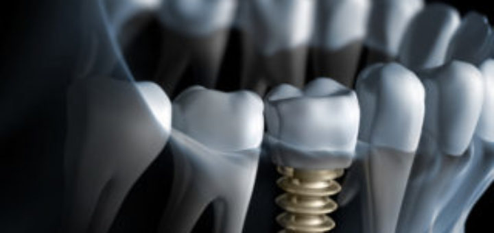 Implant Dentistry