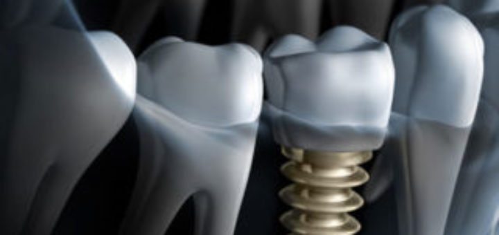 Dental Implants