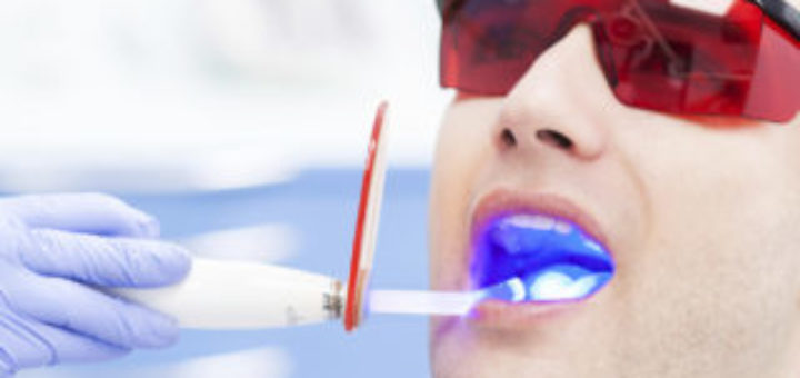 Laser Teeth Whitening