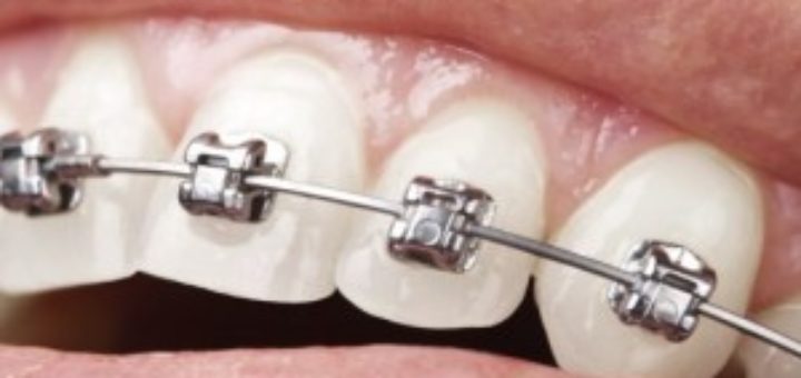 Orthodontics and Your Kids