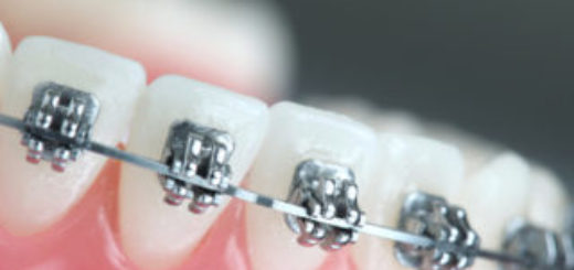 Straight Wire Braces help in Straight Teeth - Dr Sunil Dental Blog
