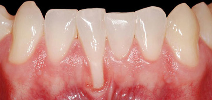 Pyorrhea Causes and Cure