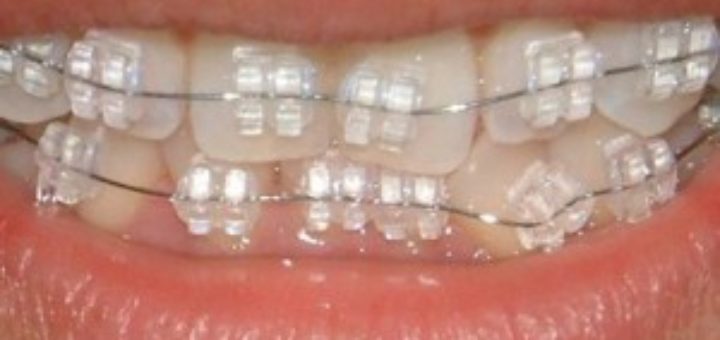 Porcelain Braces