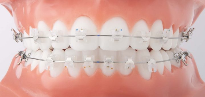 Braces