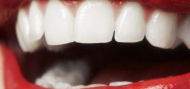 Porcelain Veneers Thailand