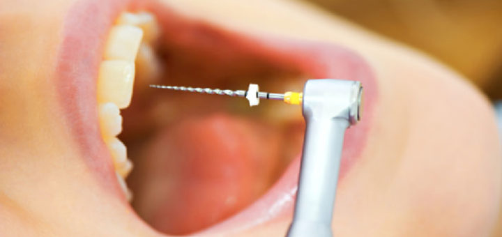 Root Canal