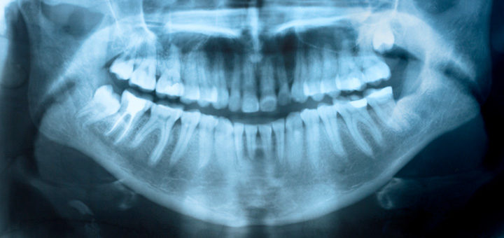 Full Mouth Reconstruction