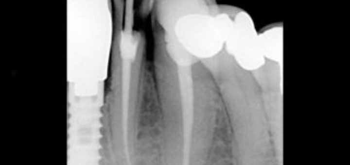 Root Canal Specialist