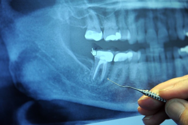 Painless Root Canal Treatment