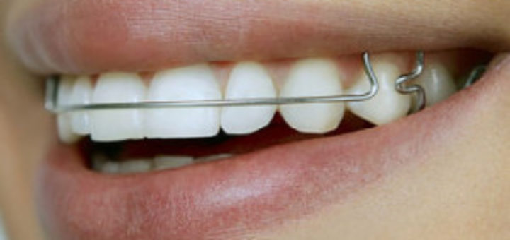 Straight Wire Braces
