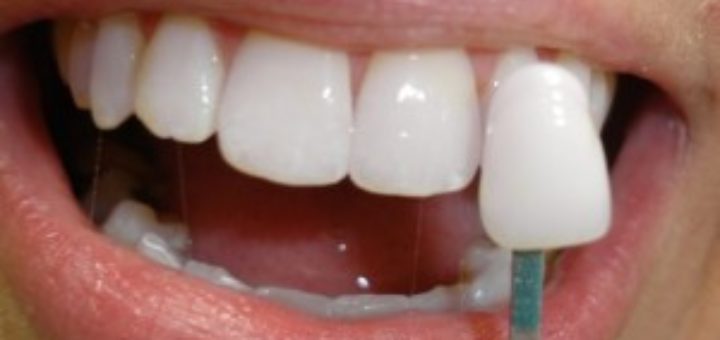 Bone Grafting