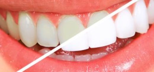 Teeth Whitening Dentist