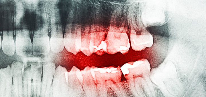 Tooth Decay