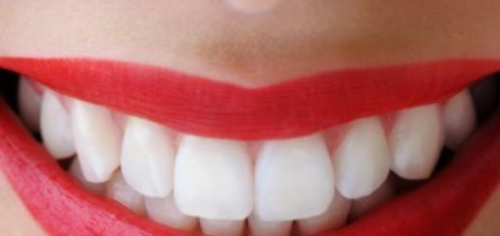 Teeth whitening cost