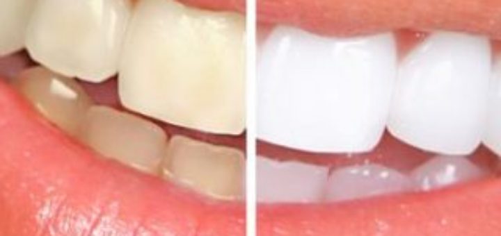 Zoom Teeth Whitening