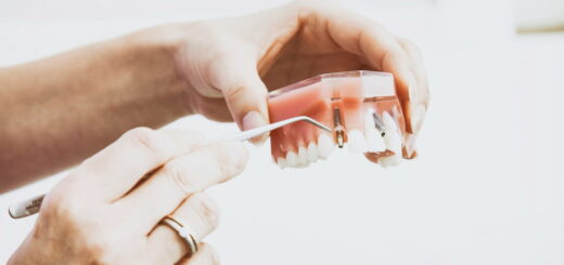 Full Mouth Reconstruction Cost