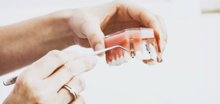 Full Mouth Reconstruction Cost