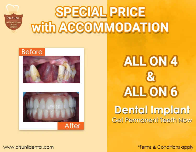 Dental Implant Offer