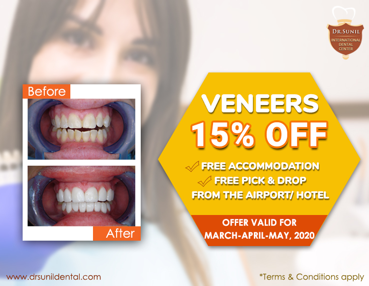 Dental Veneer Offer